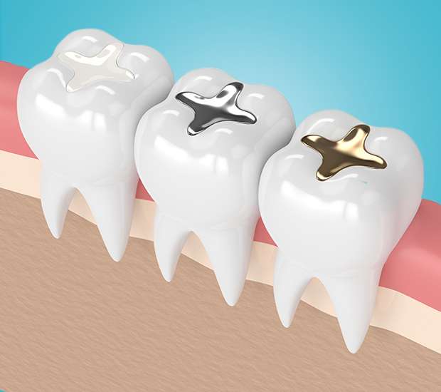 3 Ways That a Dental Filling Can Improve Your Oral Health - D&D Family  Dentistry Fredericksburg Virginia