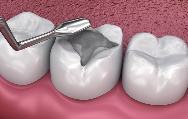 Ways That A Dental Filling Can Improve Your Oral Health
