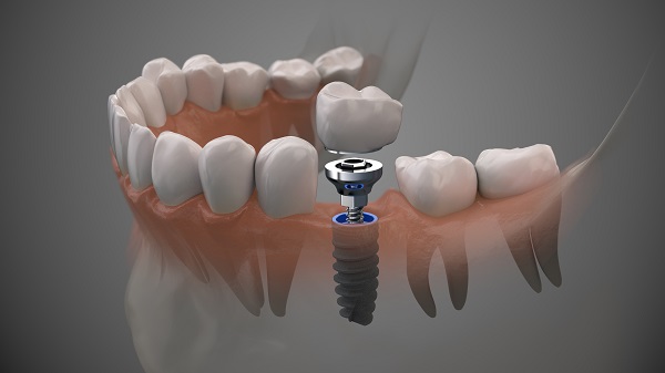 Dental Implants Fredericksburg, VA