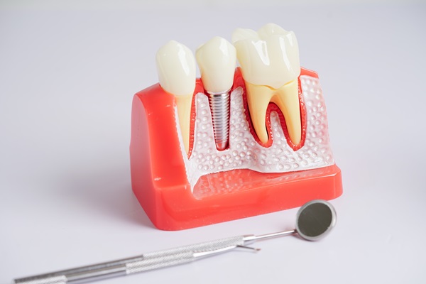 Getting Dental Implants For Dentures