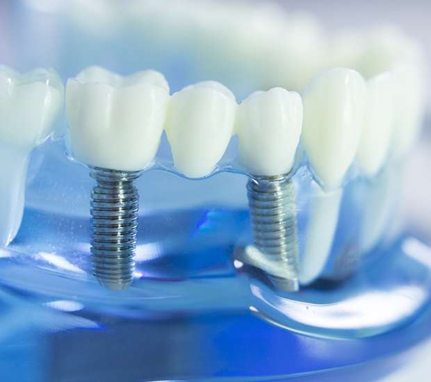 Fredericksburg Dental Implants
