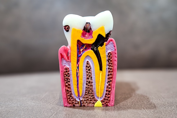 How Long Does An Implant Crown Restoration Last?