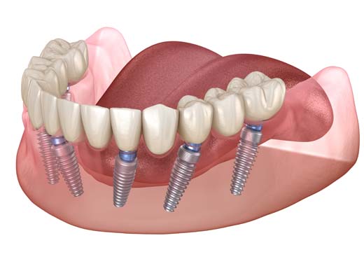 Implant Supported Dentures Fredericksburg, VA